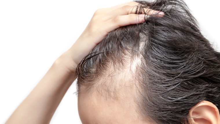 La pérdida del cabello puede llegar en cualquier momento y por distintos motivos. (Foto Prensa Libre: Shutterstock)