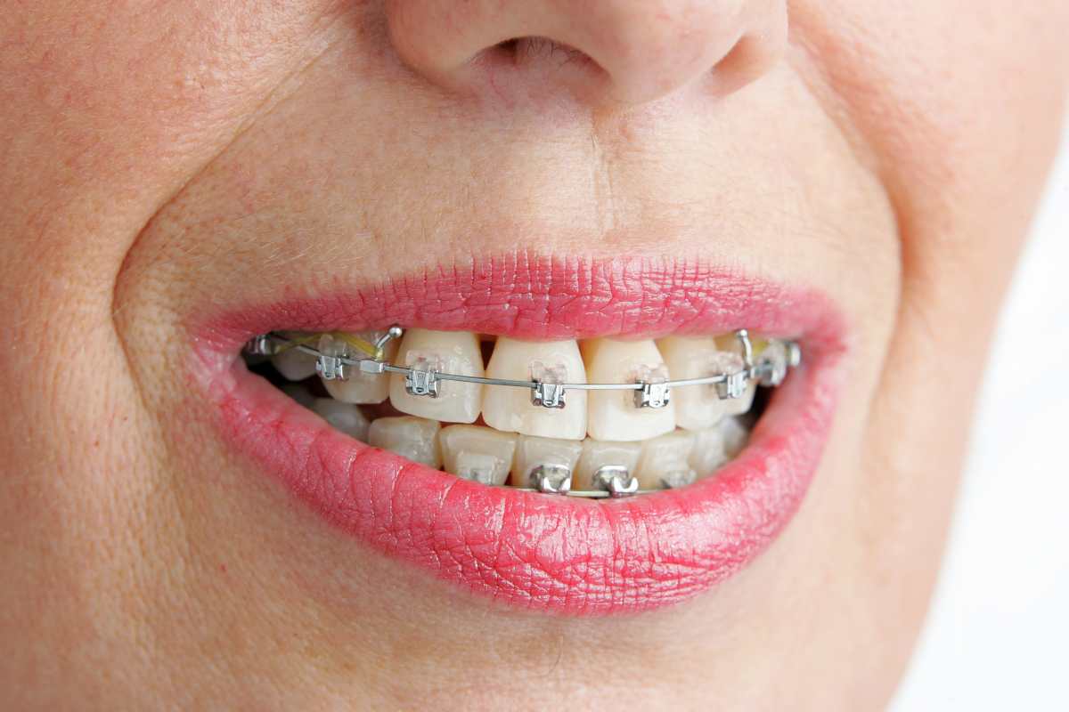 La ortodoncia también ayuda a los adultos