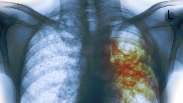 Según la OMS, los países más afectados por la tuberculosis están implicados en la lucha contra el coronavirus. (Foto Prensa Libre: Hemeroteca PL) 