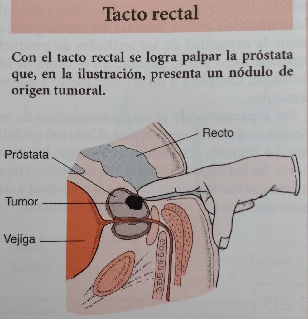 cáncer de próstata