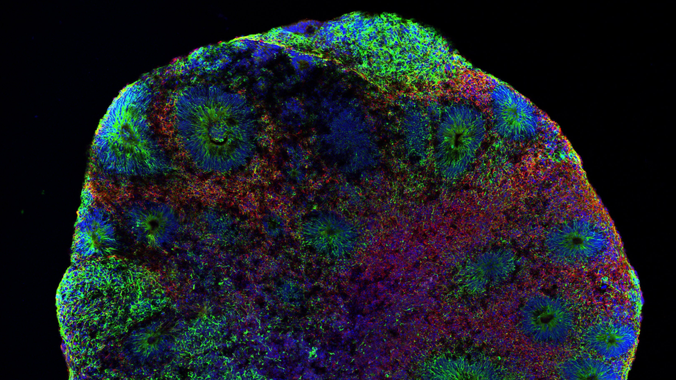 La foto de arriba revela la estructura de un organoide cerebral fabricado en Río de Janeiro. Los puntos rojos son neuronas y los puntos azules indican el núcleo celular. Las manchas verdes son progenitores neuronales, estructuras que dan lugar a células en el sistema nervioso.