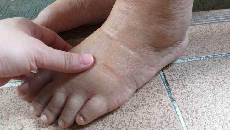 El edema es común que se presente en piernas y pies, al pasar mucho tiempo sentado o parado. (Foto Prensa Libre: Shutterstock). 