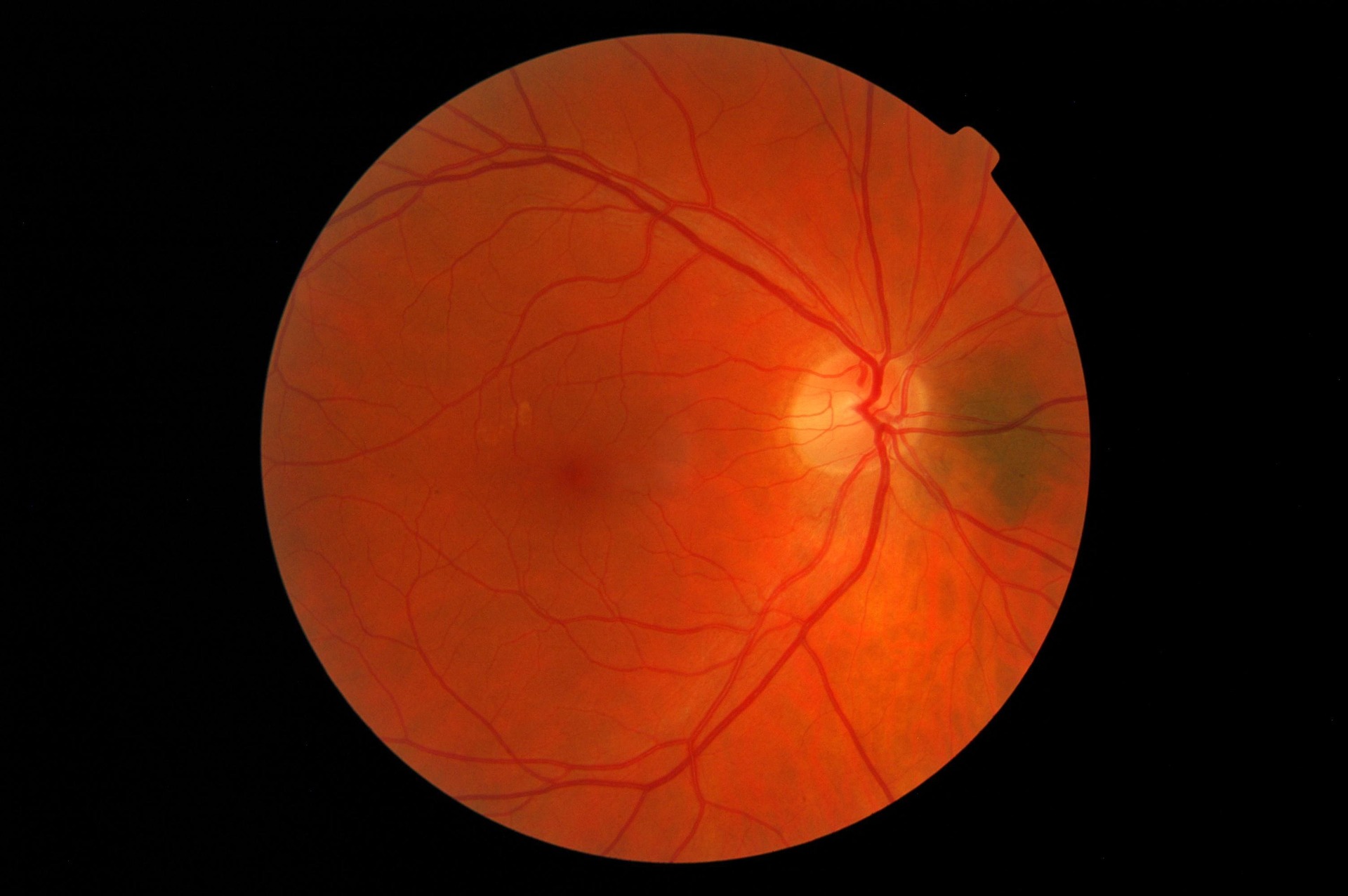 Diabetes, evitar la retinopatía