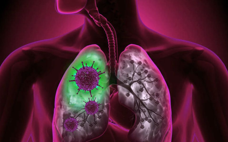 El covid-19 puede dejar severos daños en los pulmones. (Foto Prensa Libre: Tomada de MedioTiempo.com)