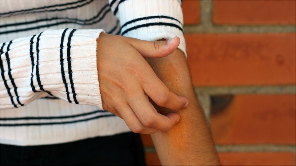 Coronavirus: el estudio que muestra que las lesiones en la piel pueden ser un síntoma de la covid-19 (y cuáles son las más comunes)