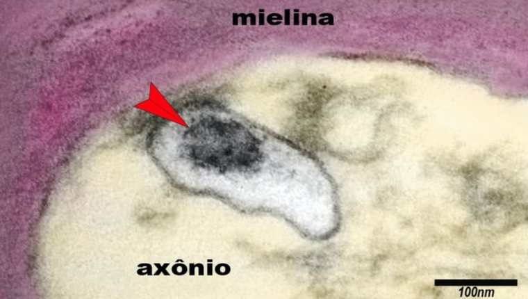 La imagen muestra un axón de una neurona en el cerebro de un niño con síndrome inflamatorio multisistémico pediátrico (SIM-P). La flecha señala al virus SARS-CoV-2 en una vesícula en el citoplasma del axón.