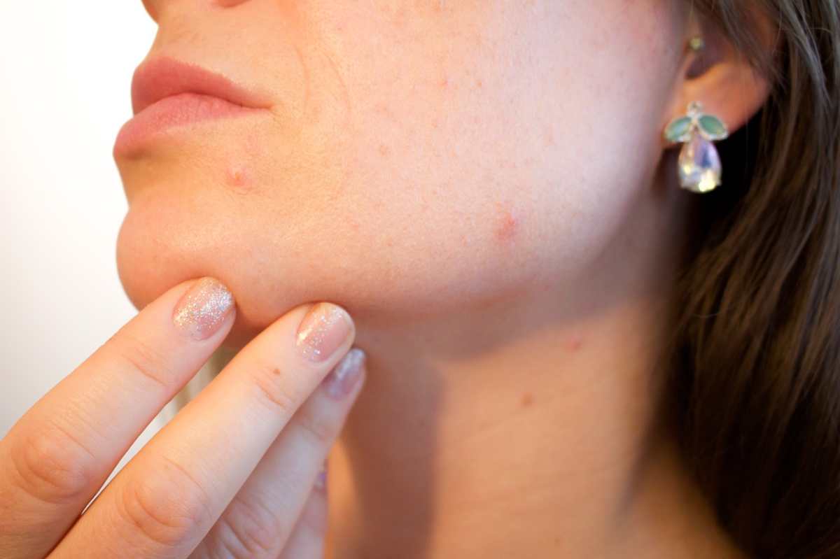 Cómo la genética afecta el desarrollo de enfermedades de la piel
