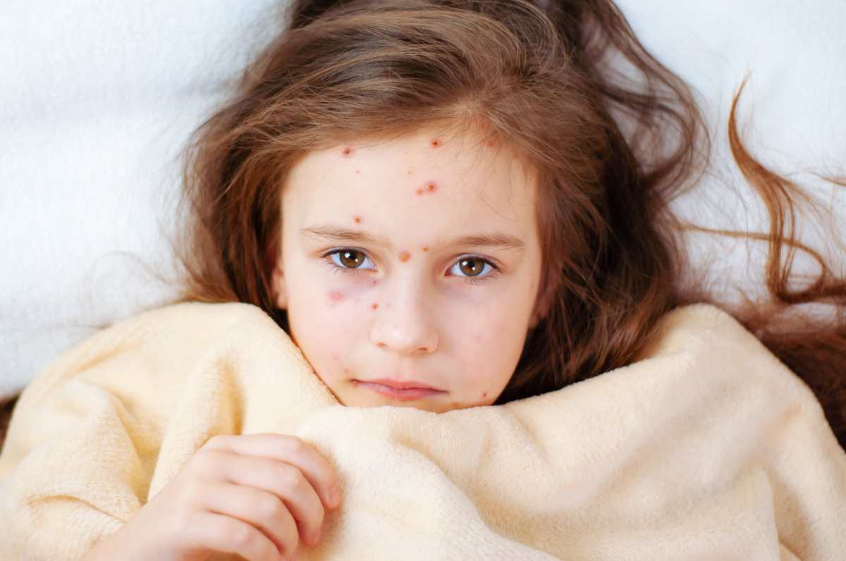 Qué es la varicela y cómo tratarla en niños y adultos