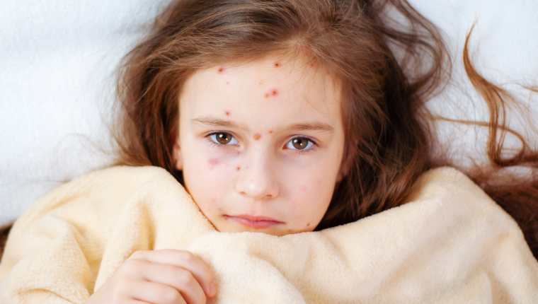 La varicela puede causar consecuencias graves tanto en adultos como niños. (Foto Prensa Libre: Shutterstock).
