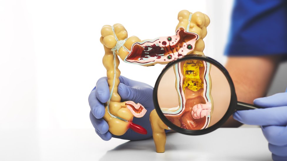 Por lo general los divertículos se desarrollan en el sigmoideo, la parte inferior izquierda del intestino grueso. (GETTY IMAGES)