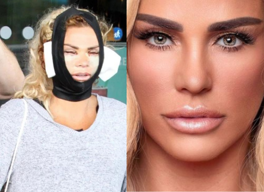 El drama de Katie Price, la exmodelo que se sometió a cinco cirugías estéticas (por qué pensó que moriría)
