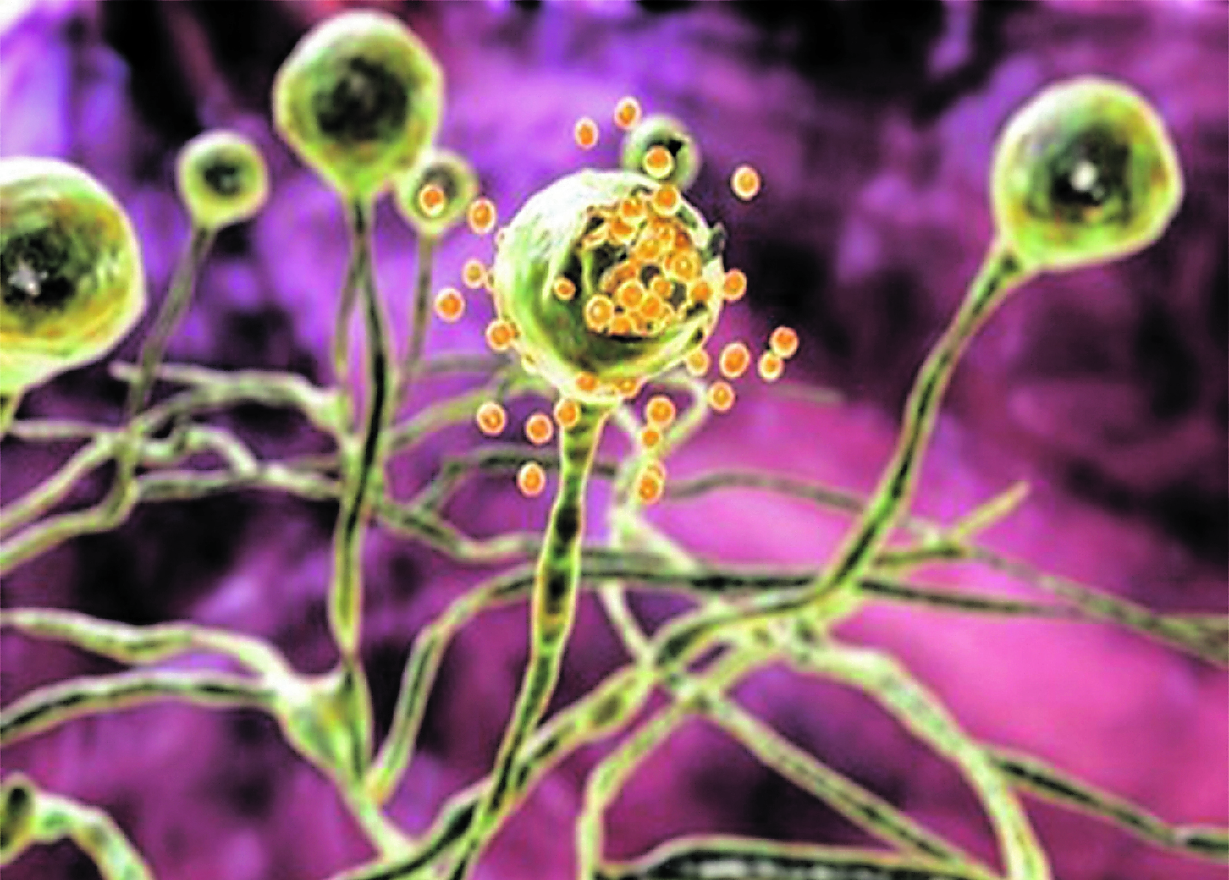 mucormicosis (hongo negro)