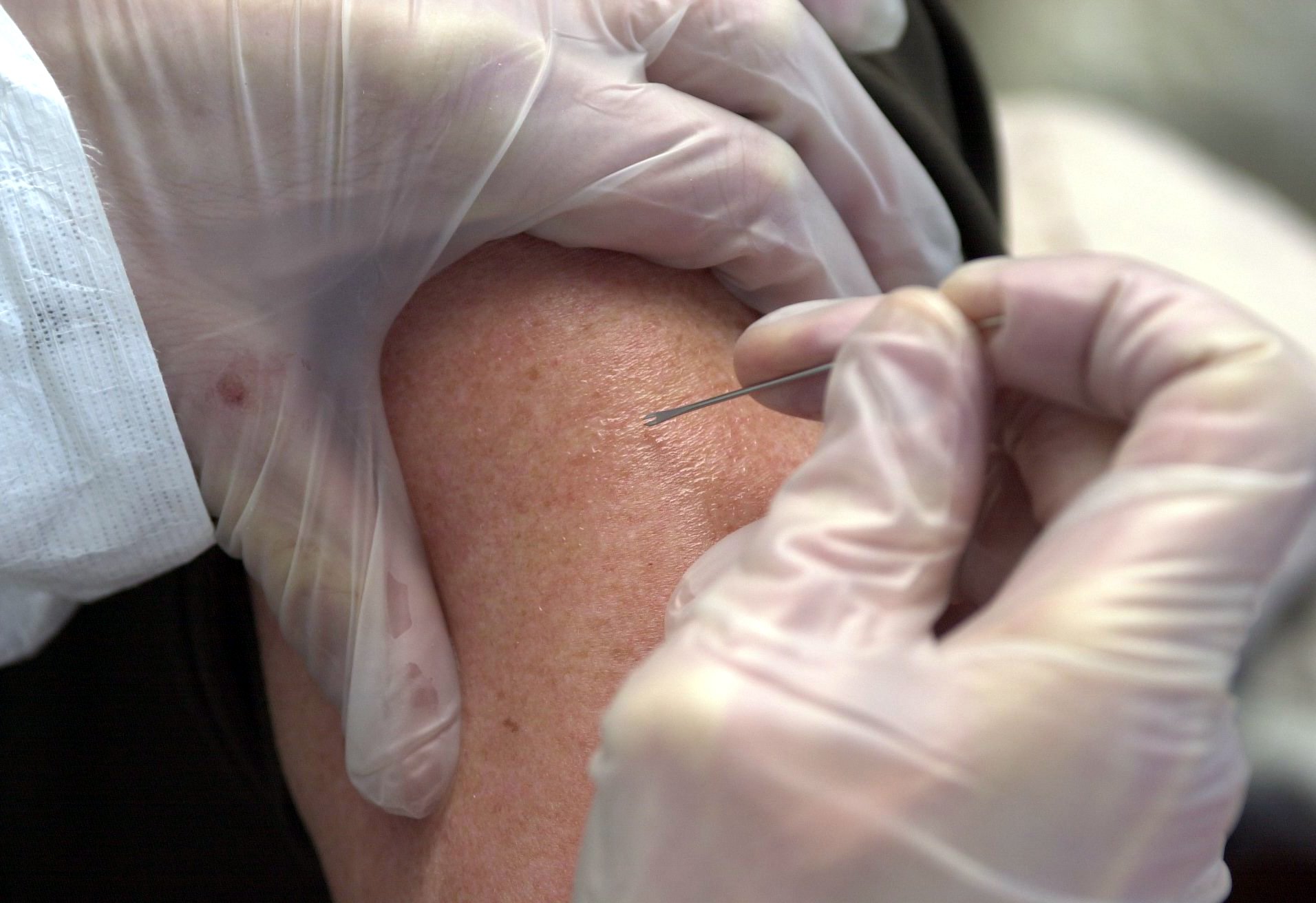 Un empleado del Departamento de Salud de Múnich sostiene una aguja en la parte superior del brazo de un extra durante un ejercicio de vacunación contra la viruela en Múnich. Foto: Guido Bergmann/dpa