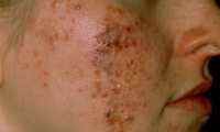 La lesión elemental del acné es el comedón, que consiste en un folículo dilatado y lleno de sebo. Foto Prensa Libre: cedida