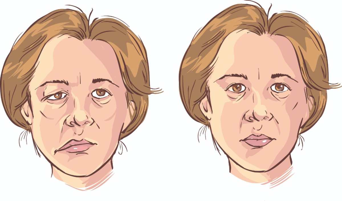 ¿Qué hacer frente a una parálisis facial?