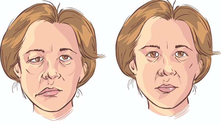 La parálisis facial se presenta con la pérdida total o parcial de movimiento muscular voluntario en un lado de la cara. (Ilustración Prensa Libre: Shutterstock)