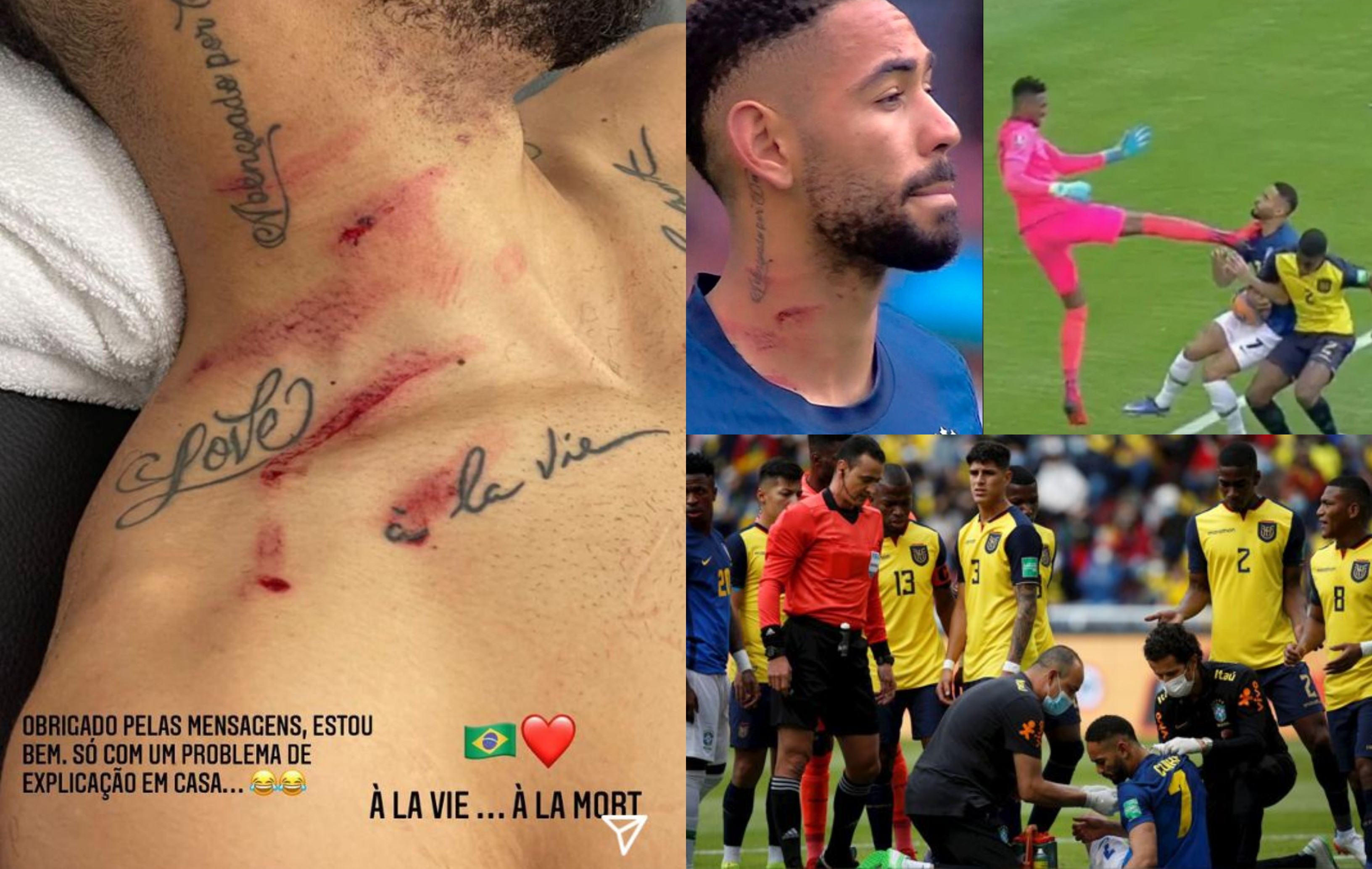 El jugador brasileño Cunha publicó en Instagram una foto donde muestra cómo le quedó el cuello tras la patada del portero ecuatoriano Alexander Domínguez. Foto redes sociales. 