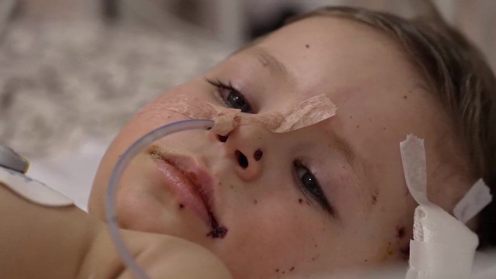 Niños heridos en Ucrania