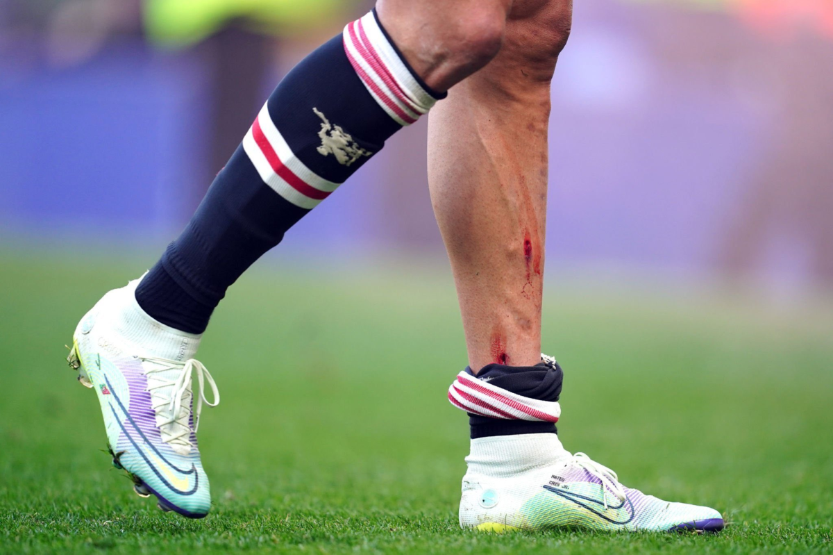 Así quedó la pierna de Cristiano Ronaldo tras una dura entrada en la derrota del Manchester United ante el Everton