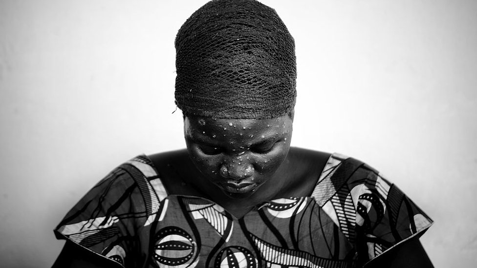 Se han reportado casos de la enfermedad por años en África.