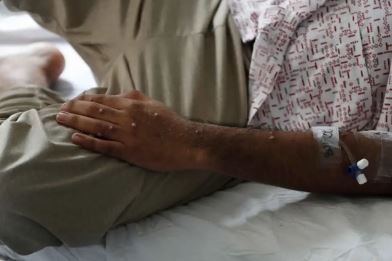 Viruela del mono: El Salvador confirma su primer caso de la enfermedad en una mujer de 28 años