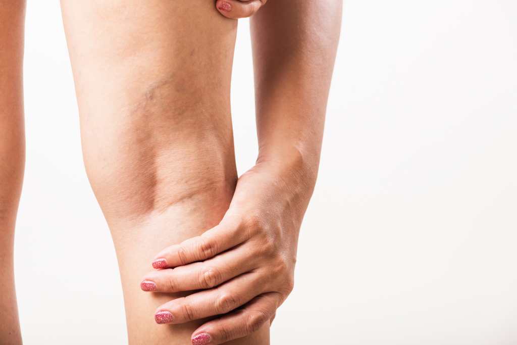 Así pueden mejorar sus piernas hinchadas, siga estas ocho recomendaciones 