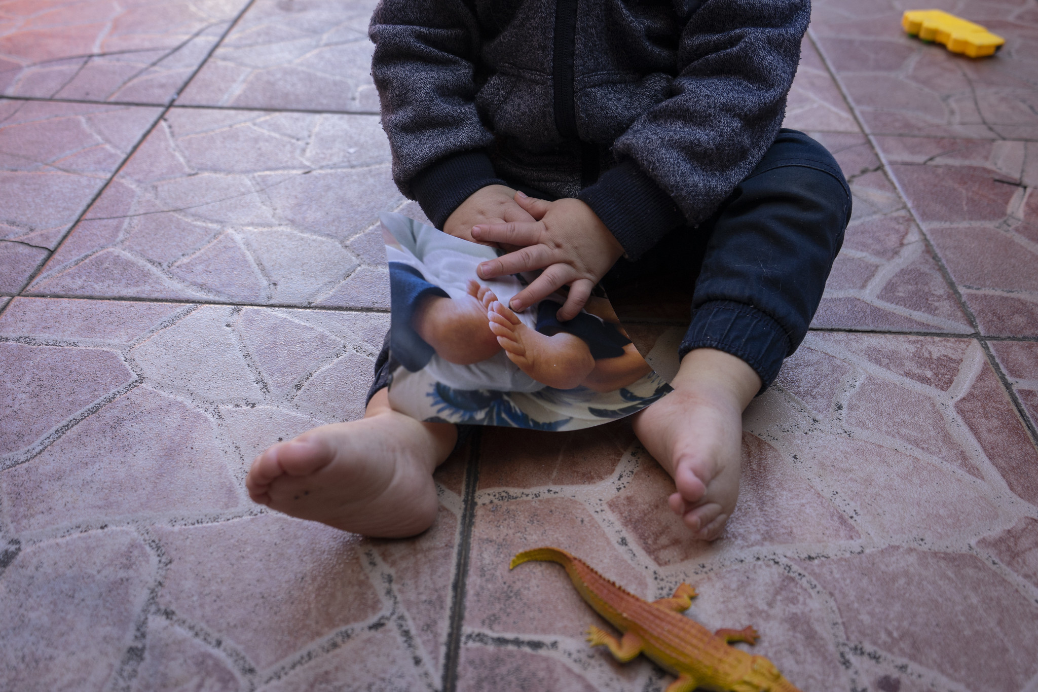 Pie equino varo Qué es esa condición congénita y por qué es de las más