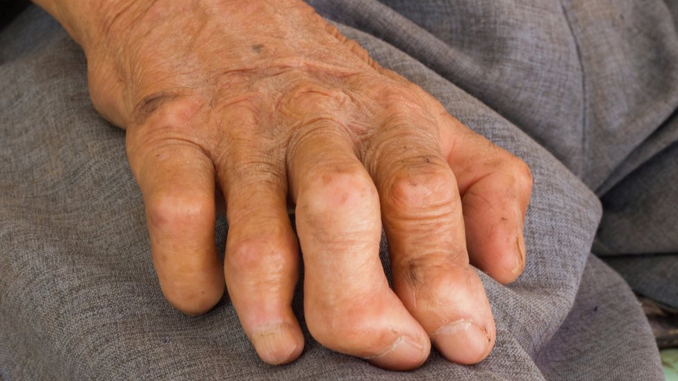La lepra puede dañar los nervios y provocar discapacidad.

Getty Images