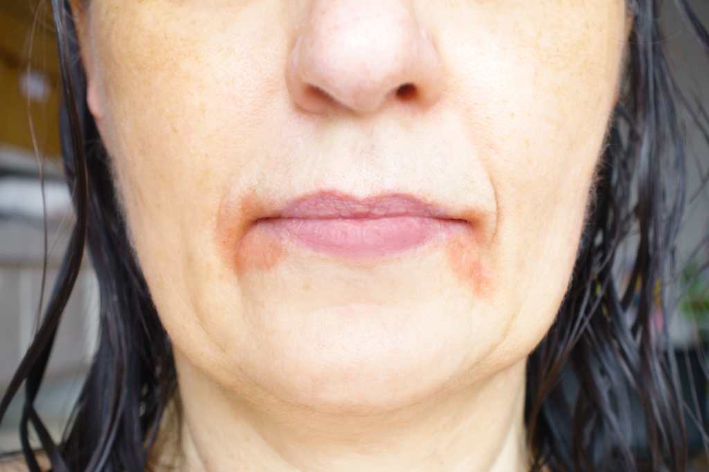Por qué se pone roja la cara y arde - dermatitis perioral