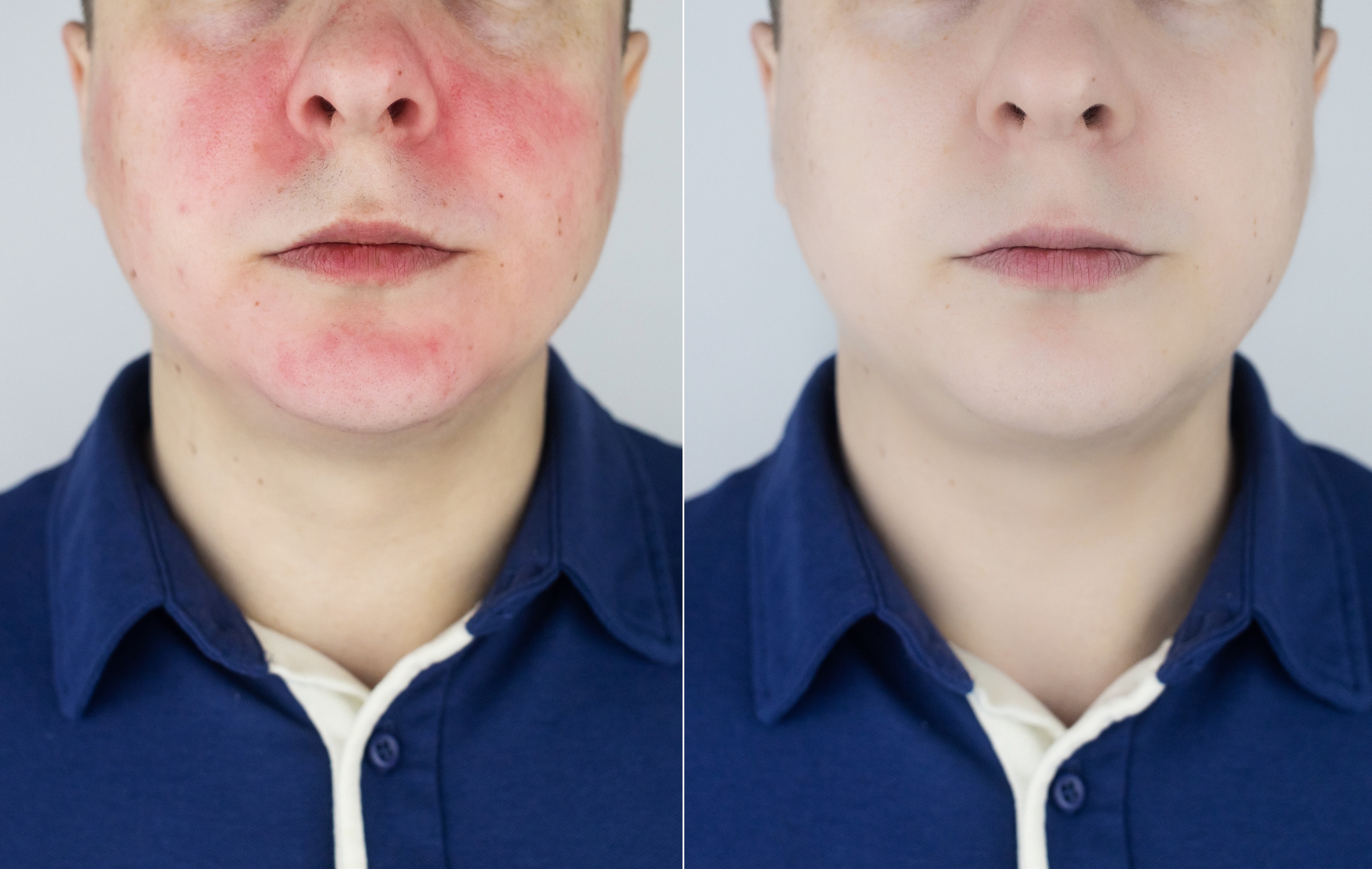 ¿Por qué se pone roja la cara?: Las enfermedades más comunes que lo provocan y cómo prevenirlas