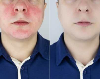 ¿Por qué se pone roja la cara?: Las enfermedades más comunes que lo provocan y cómo prevenirlas