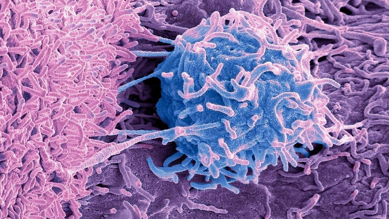 Las bacterias y hongos también viven en los tumores.
GETTY IMAGES
