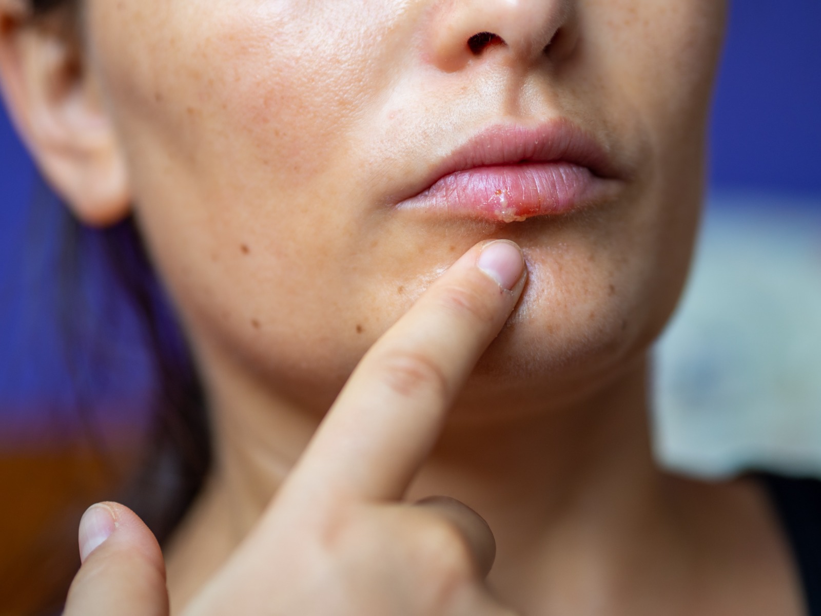 Herpes labial: qué es, síntomas, causas y remedios caseros para calmarlo (¿por qué le llaman “fuego en la boca”?)
