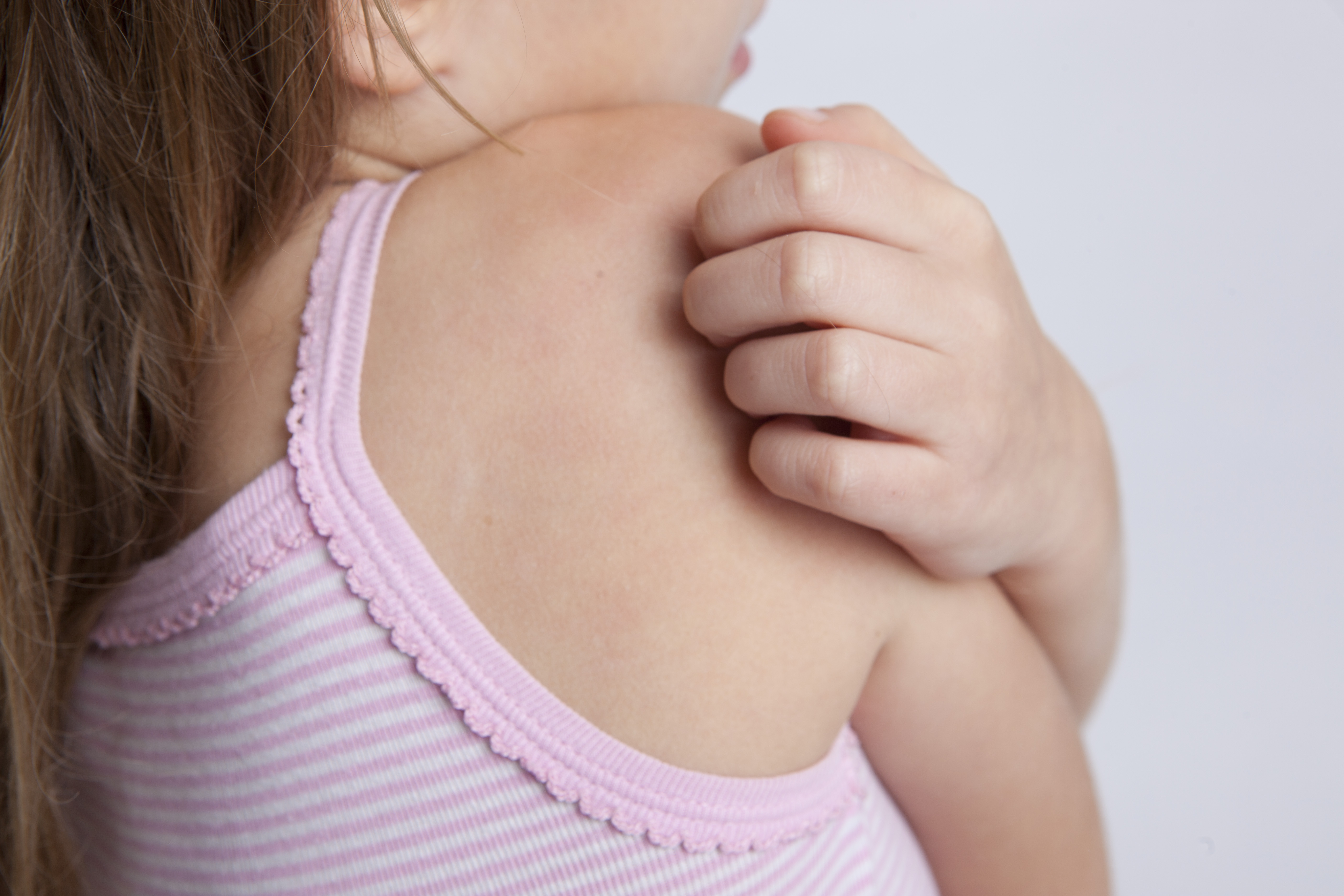 Guía rápida de picaduras de insectos en niños