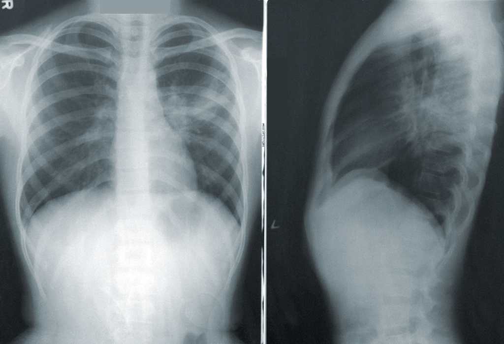 Neumonia radiografia torax