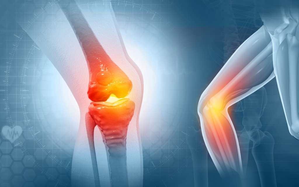 Artrosis de rodilla síntomas y causas (2)