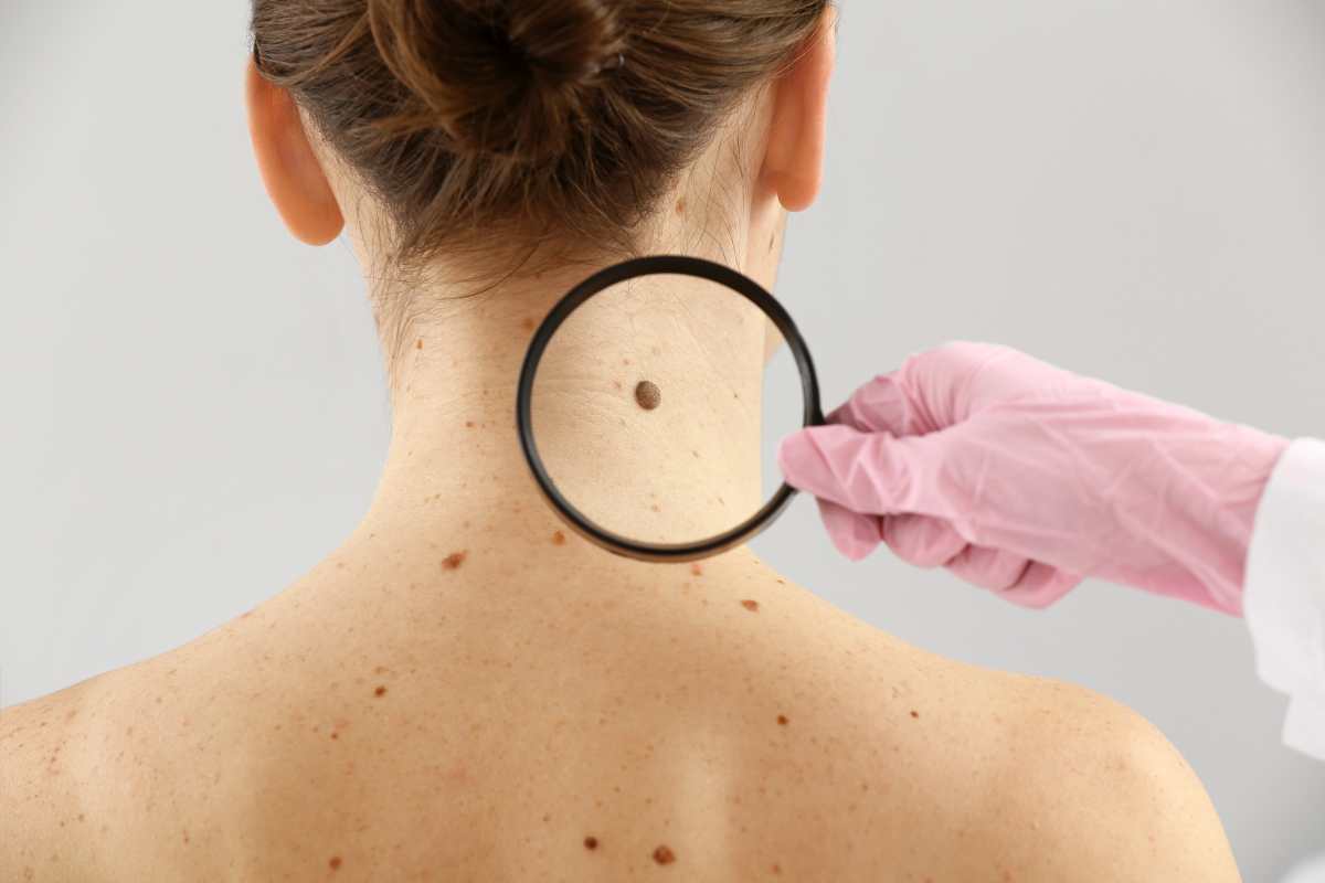 Síntomas del cáncer de piel