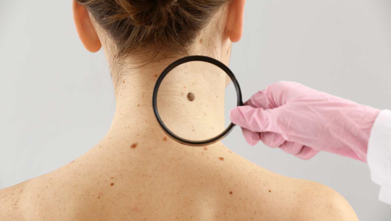 Síntomas del cáncer de piel