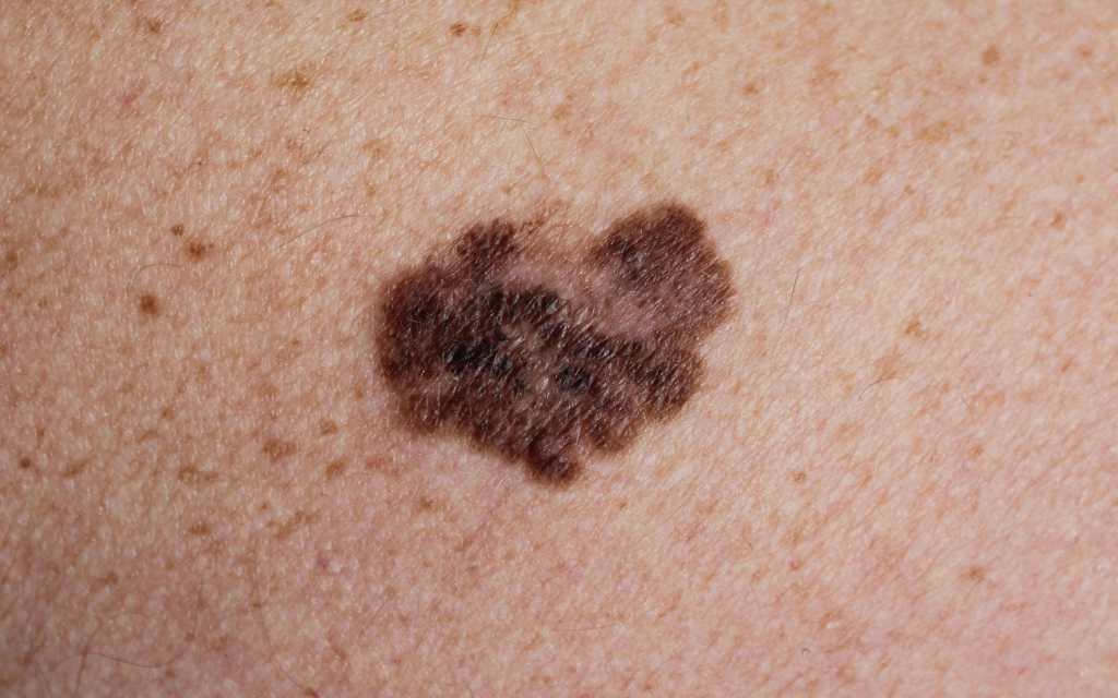 Melanoma Tipo de cáncer de piel