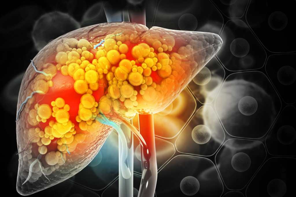 La epidemia silenciosa: ¿Cómo podemos prevenir el hígado graso?