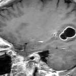 Esta imagen de resonancia magnética permite apreciar la lesión causada por la tenia del cerdo.