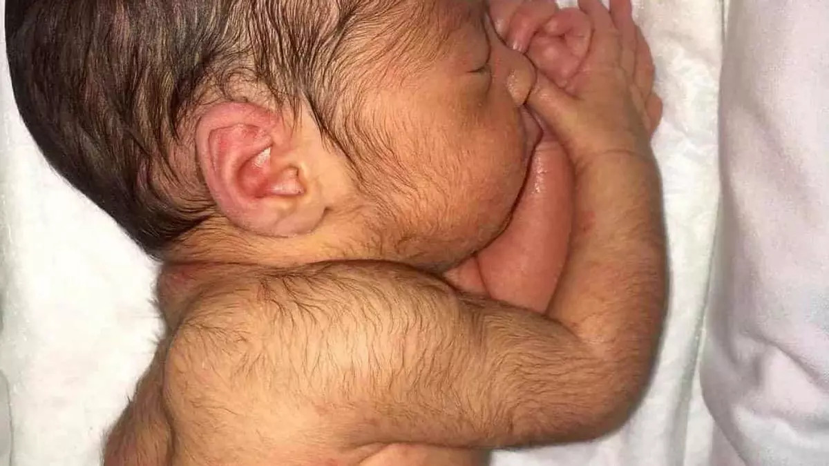 Bebés con “síndrome del hombre lobo”: el insólito efecto secundario del minoxidil