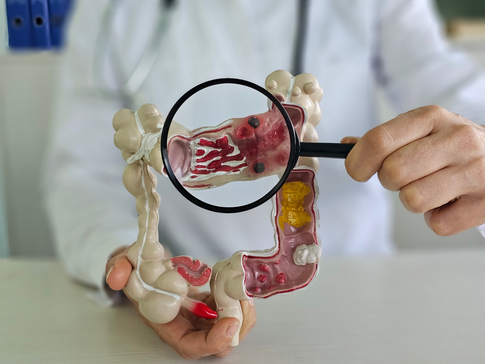 Tomar una aspirina al día podría ayudar a reducir el riesgo de cáncer de colon