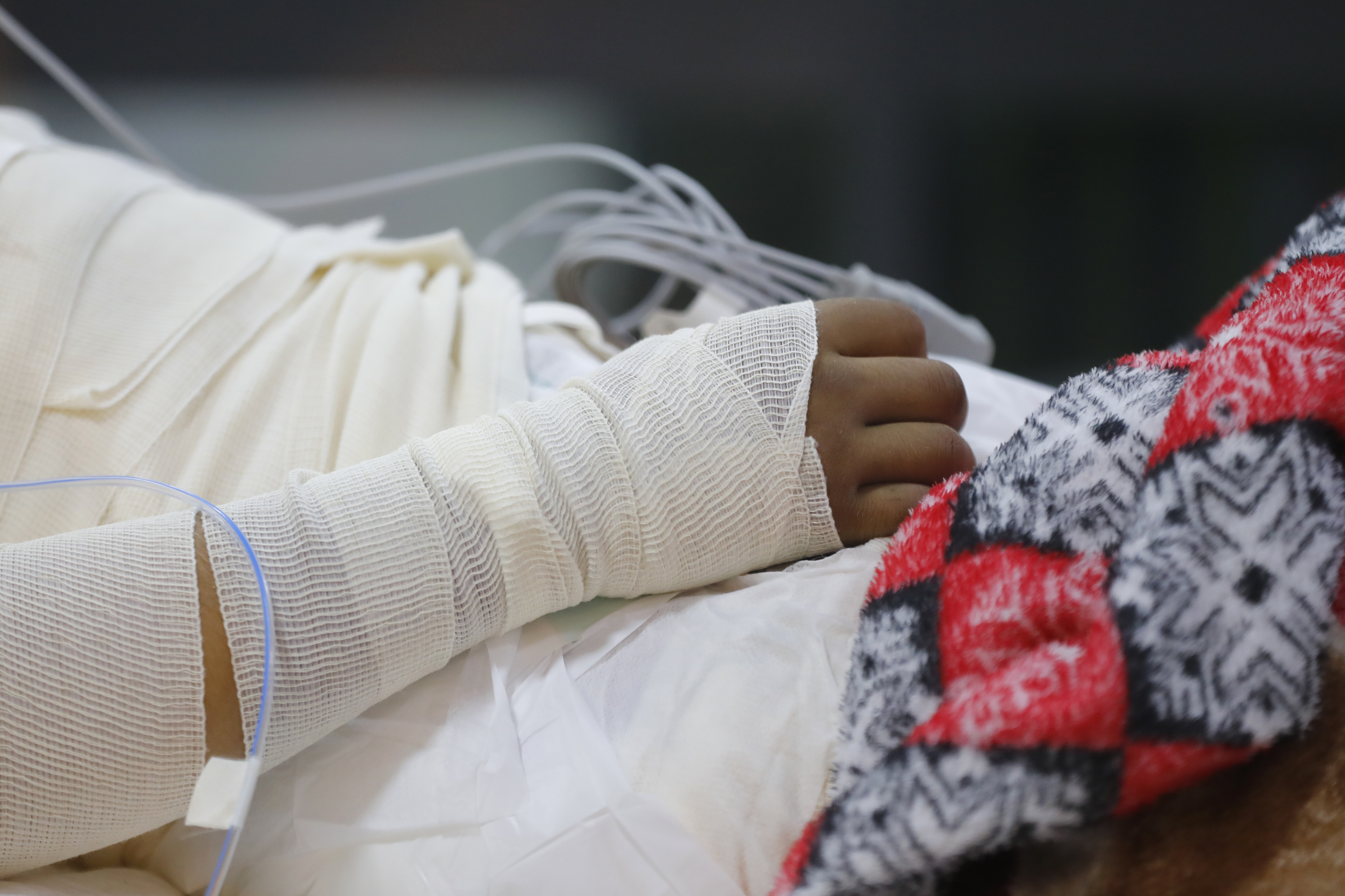 MEX1119. GUADALAJARA (MÉXICO), 27/04/2025.- Un paciente permanece en una habitación de la Unidad de Atención Integral a Niñas, Niños y Adolescentes con Quemaduras del Hospital Civil Fray Antonio Alcalde este viernes, en Guadalajara (México). Las quemaduras por pirotecnia, bromas que se salen de control y pugnas de grupos del crimen organizado son cada vez más comunes en adolescentes en México, alertan especialistas del Hospital Civil de Guadalajara, referente a nivel nacional en atender niños quemados. EFE/ Francisco Guasco