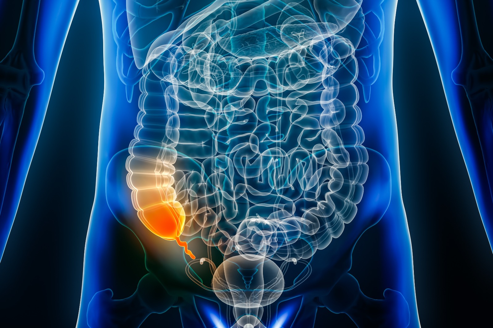 ¿Para qué sirve el apéndice y qué ocurre si te lo extirpan? Conoce su función y cómo prevenir la apendicitis