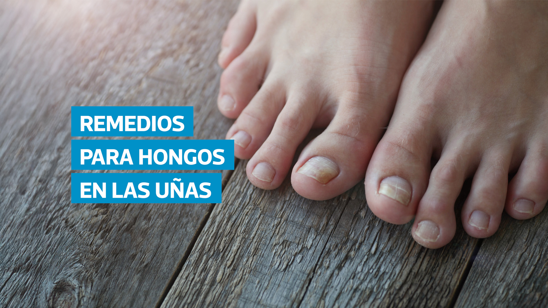 VIDEO | Remedios efectivos contra los hongos en las uñas | Prensa Libre