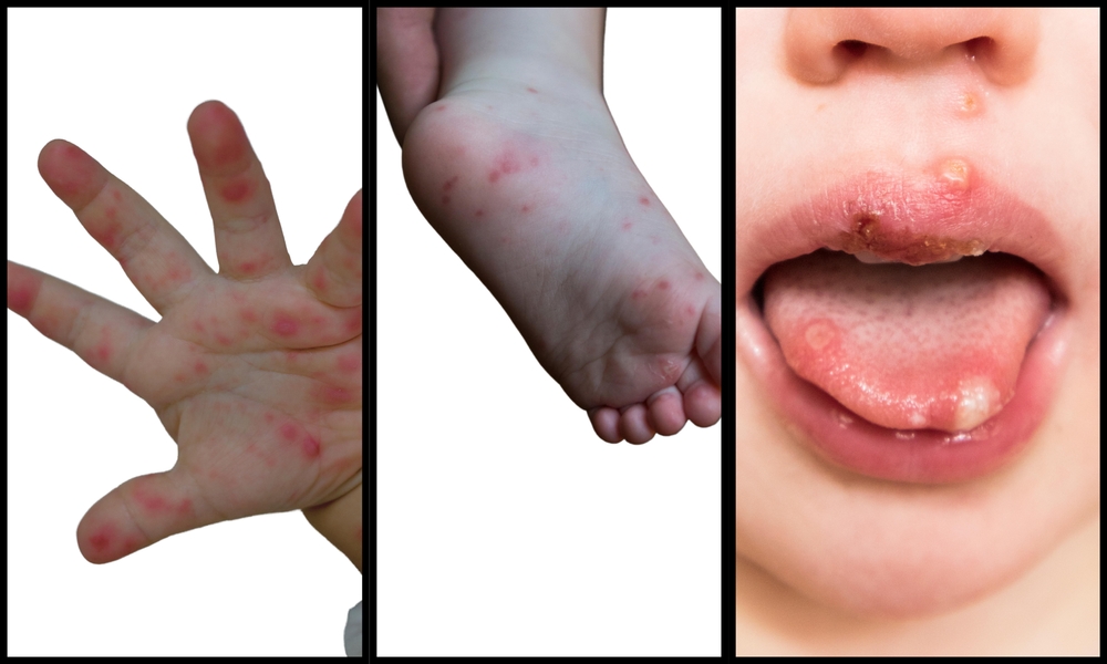 Erupciones y llagas caracterÃsticas de la enfermedad mano, pie y boca causadas por el virus Coxsackie en niños, en manos, pies y boca.