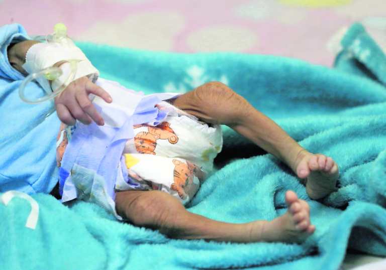 Fallecen 51 niños por desnutrición aguda en Guatemala; hay muertes en más departamentos que en el 2