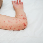 CASOS DE SARAMPIÓN CASOS DE SARAMPIÓN