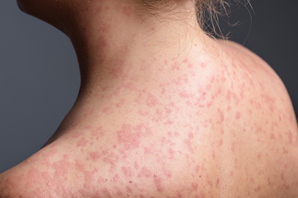 Cada caso de sarampión puede contagiar a 12 y 18 personas más que no estén vacunadas, lo que puede llevar a una rápida diseminación del virus en el país. (Foto Prensa Libre: Shutterstock)